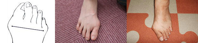 Photo: 靭帯性外反母趾